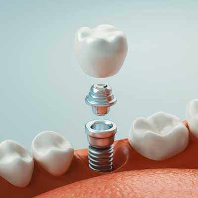 implantología oral en Barcelona y Gavá, dentista en Barcelona y Gavá, clínica dental en Barcelona y Gavá.