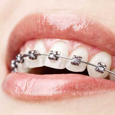 ortodoncia en Barcelona y Gavá, dentistas en Barcelona y Gavá, clínica dental en Barcelona y Gavá.