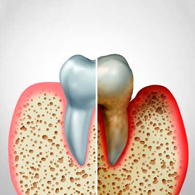 periodoncia en Barcelona y Gavá, dentista en Barcelona y Gavá, clínica dental en Barcelona y Gavá.