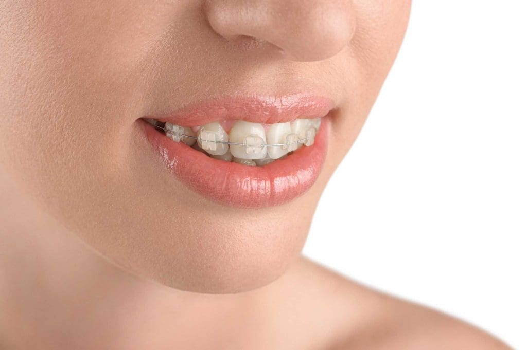 ortodoncia en Barcelona y Gavá, dentistas en Barcelona y Gavá, clínica dental en Barcelona y Gavá.