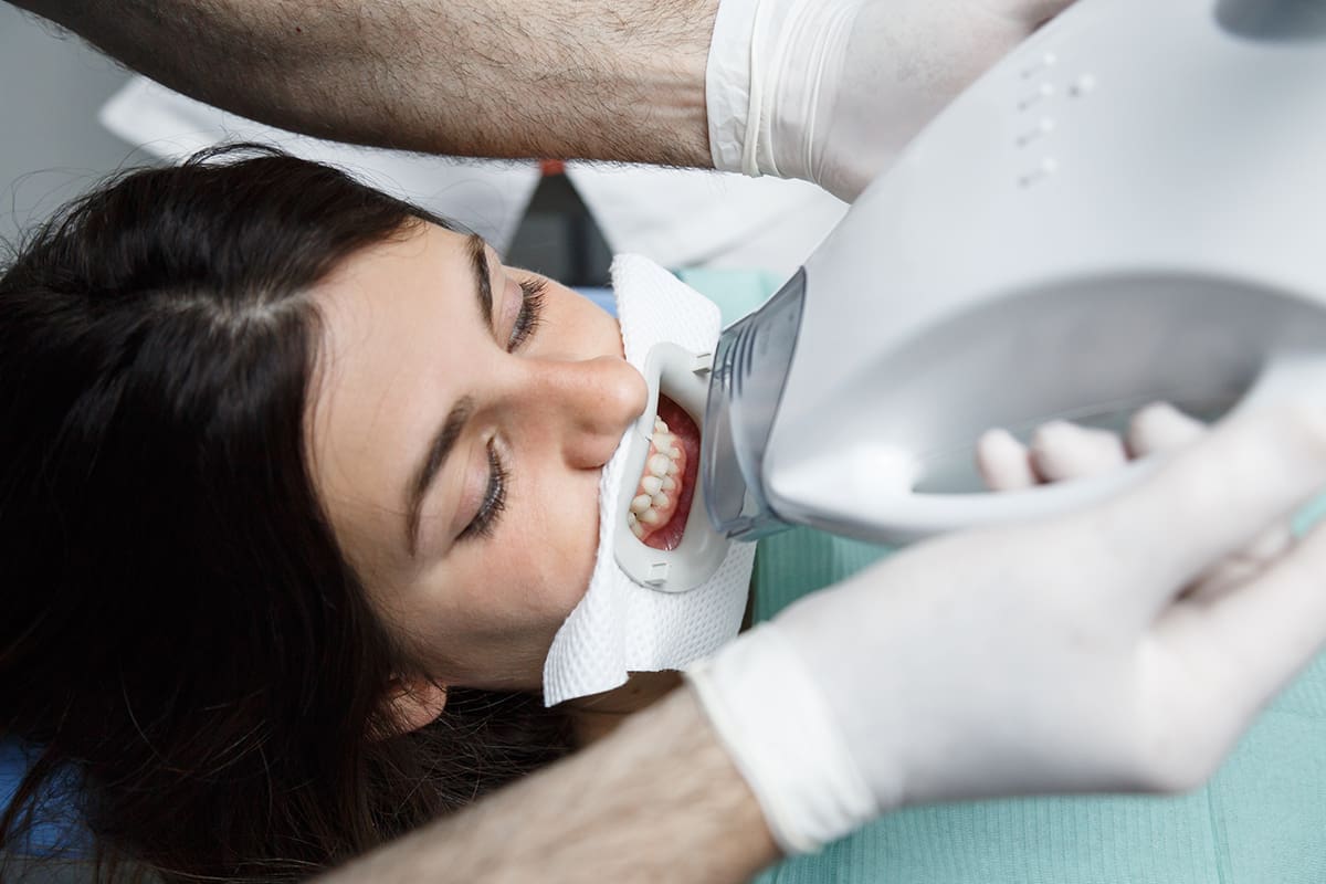 Blanqueamiento o carillas: ¿qué tratamiento de estética dental necesito?