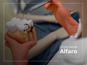 Caries dentales