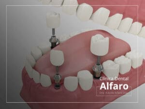 Implantes de carga inmediata