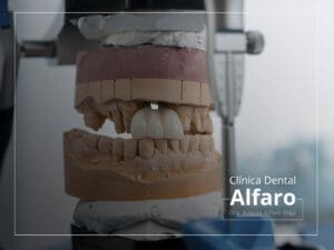 Implantes múltiples