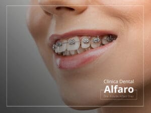 Ortodoncia convencional (Brackets metálicos)