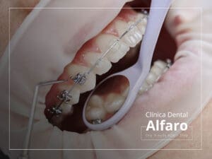 Ortodoncia transparente (Brackets de zafiro)