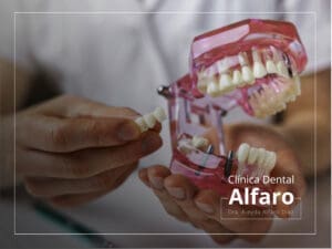Protesis sobre implantes