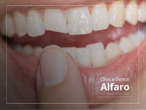 Reconstrucción dental